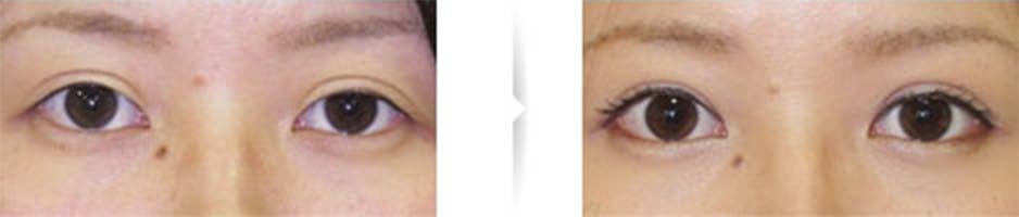 手術の傷跡を治し、幅広二重を修正