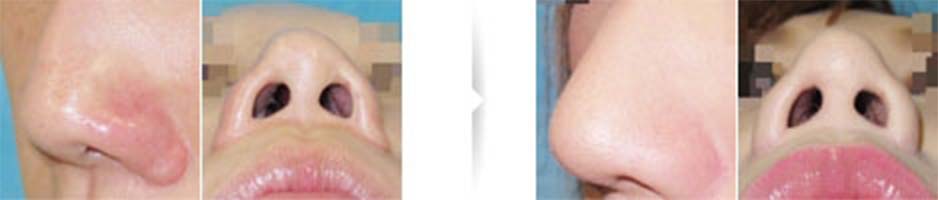 歪んだ鼻を、根本的に修正