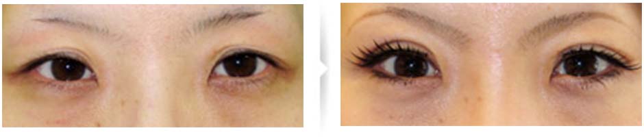 二重切開済み、二重のラインが2本になった