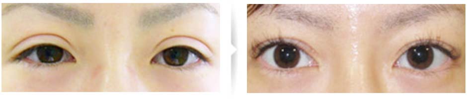 二重切開済、幅が広く眠たそうに見える