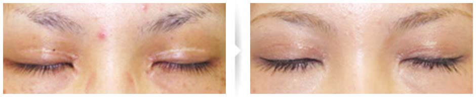 二重切開+目頭切開済み、傷と凹み