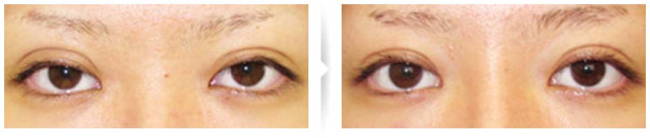 二重切開済み、幅が広すぎる、二重の形