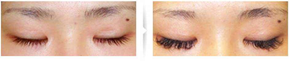 部分切開後のまぶたの凹み