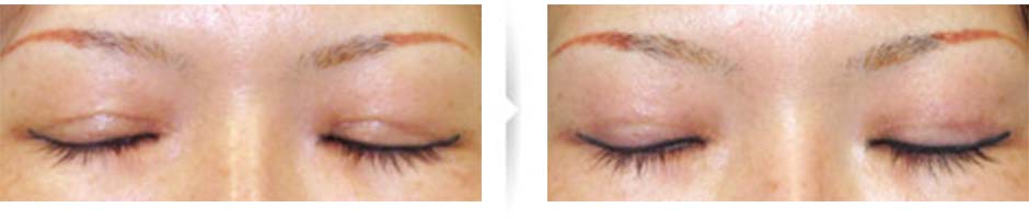 二重切開後の傷の凹みと形(テレビ取材にご協力いただきました)