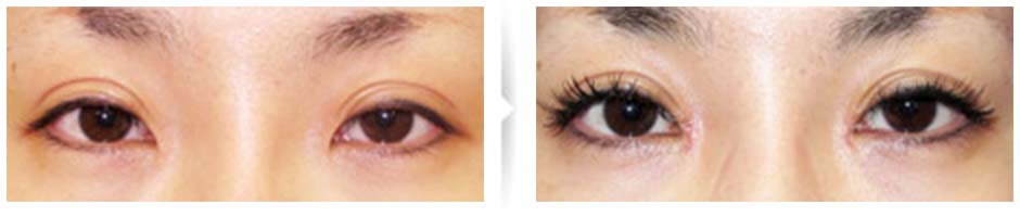 目頭切開後、目頭の形と効果