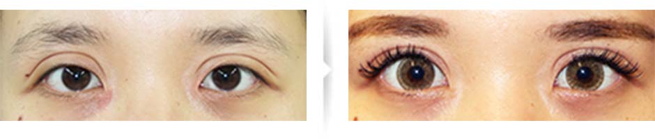 二重切開済み、不自然な広い二重