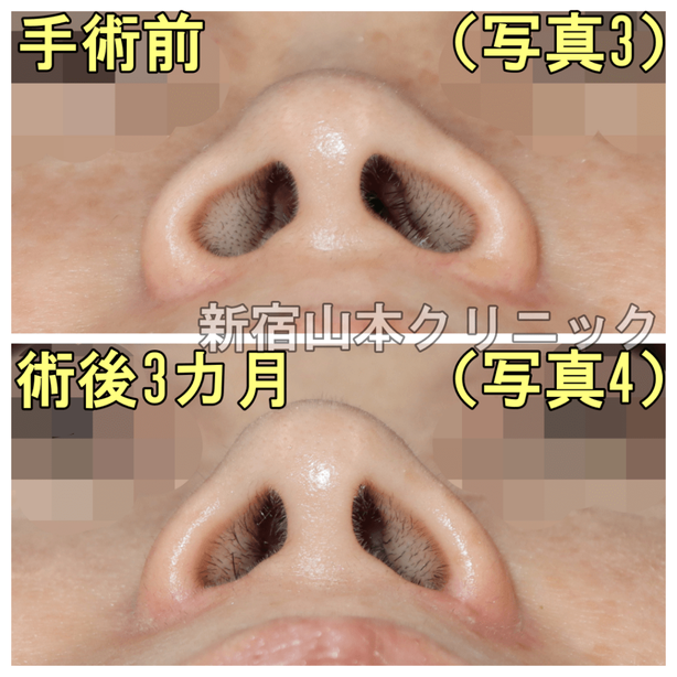 下から見た小鼻縮小術（鼻翼縮小）の術前術後比較