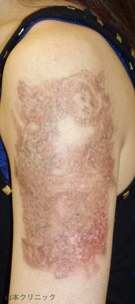 Wレーザー一回でタトゥー 刺青 は消える ビフォーアフター写真で比較 美容外科話 美容外科 美容整形修正の名医は東京新宿の山本クリニック
