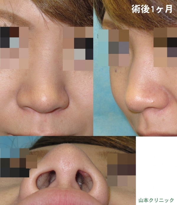 鼻尖軟骨縫縮 団子鼻手術 痩せたように見える効果と術後の腫れ方 美容外科話 美容外科 美容整形修正の名医は東京新宿の山本クリニック