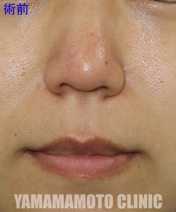 人中短縮のポイント 小鼻の外側まで切らないで鼻の下を短くすると美人になれる 美容外科話 美容外科 美容整形修正の名医は東京新宿の山本クリニック