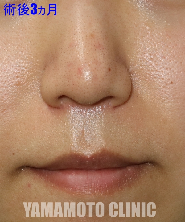 人中短縮のポイント 小鼻の外側まで切らないで鼻の下を短くすると美人になれる 美容外科話 美容外科 美容整形修正の名医は東京新宿の山本クリニック