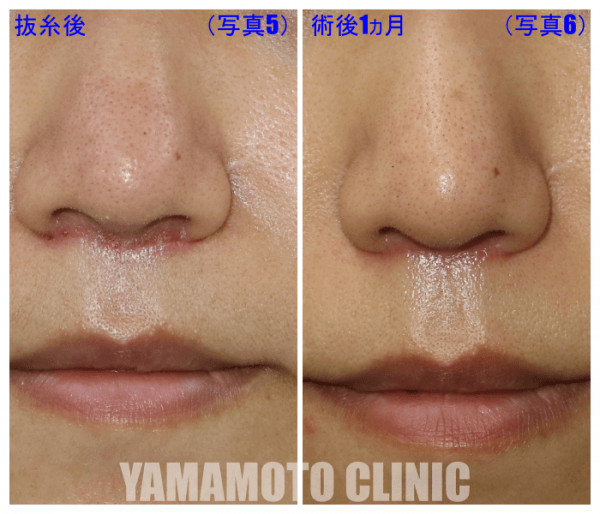 人中短縮のポイント 小鼻の外側まで切らないで鼻の下を短くすると美人になれる 美容外科話 美容外科 美容整形修正の名医は東京新宿の山本クリニック