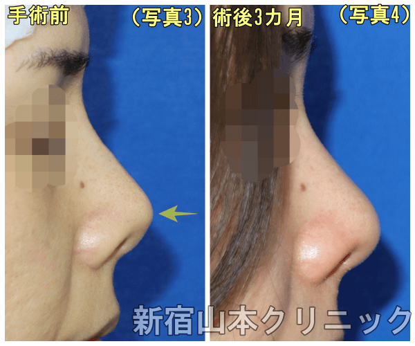 鼻プロテーゼ シリコン 他院整形で上に向いてきた鼻の修正 美容外科話 美容外科 美容整形修正の名医は東京新宿の山本クリニック 鼻プロテーゼ シリコン 他院整形で上に向いてきた鼻の修正 美容外科話 美容外科 美容整形修正の名医は東京新宿の山本クリニック